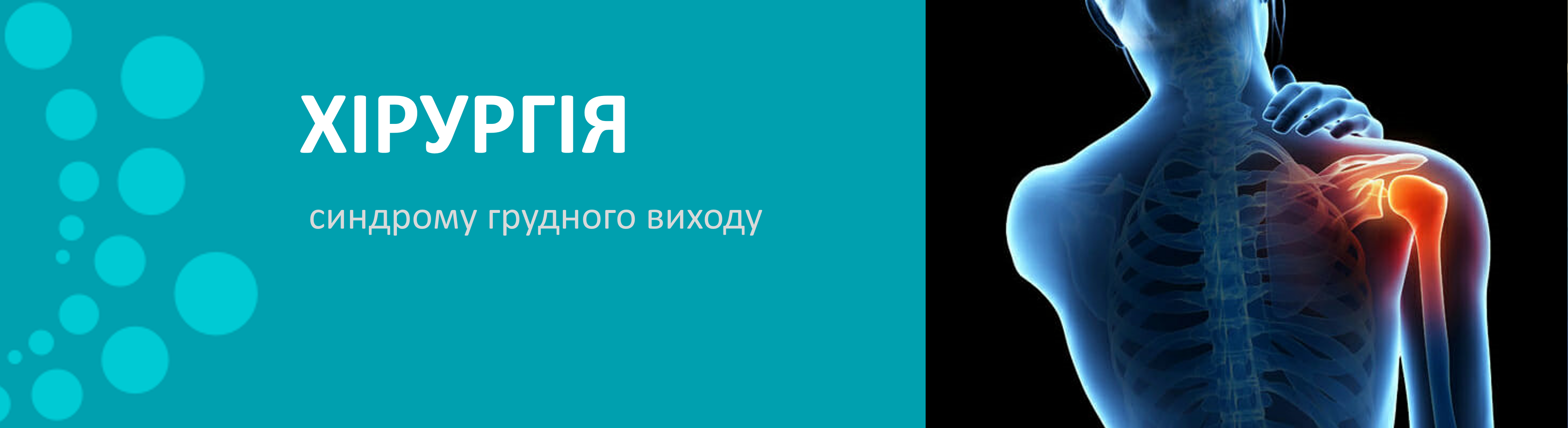 Синдром грудного виходу