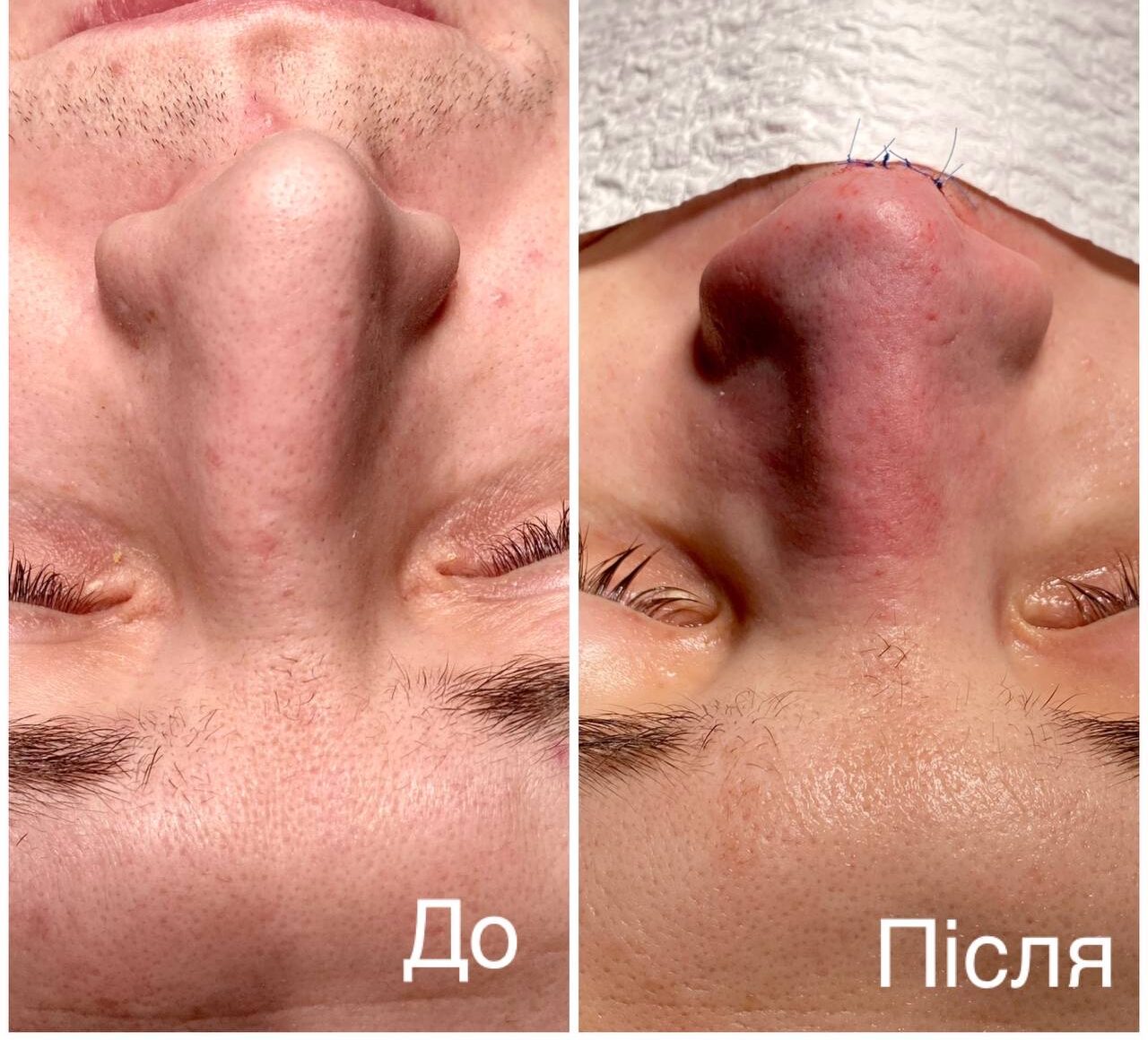 Септопластика в Києві